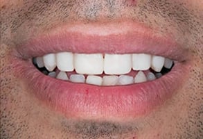 Before and After Photos
